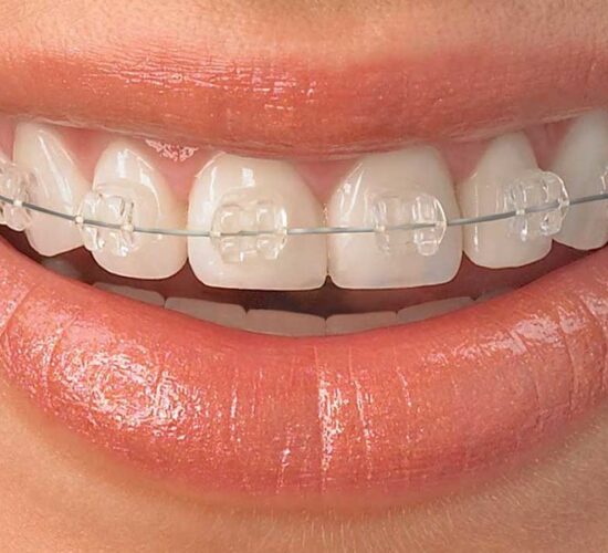 Braces or Clips Treatment