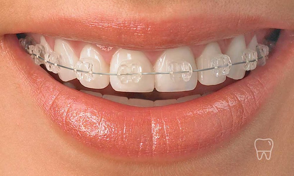 Braces or Clips Treatment