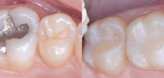 Cosmetic Treatment (Fillings)