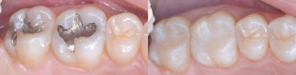 Cosmetic Treatment (Fillings)