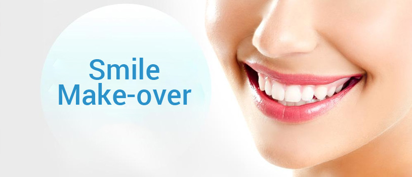 Smile makeover