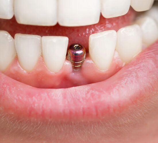 Dental Implants