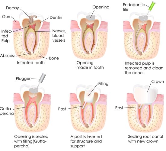 Root Canal Treatment