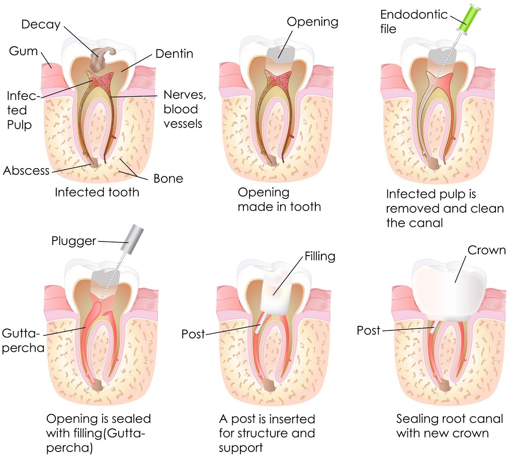 Root Canal Treatment