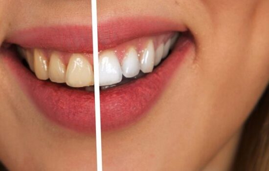 Teeth Cleaning & Whitening