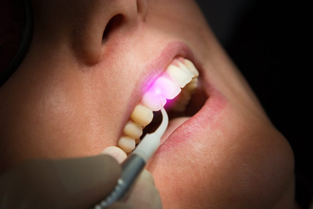 Laser Gum Surgery