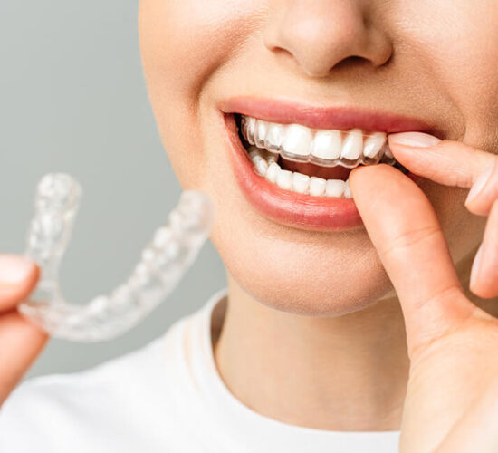 Aligners