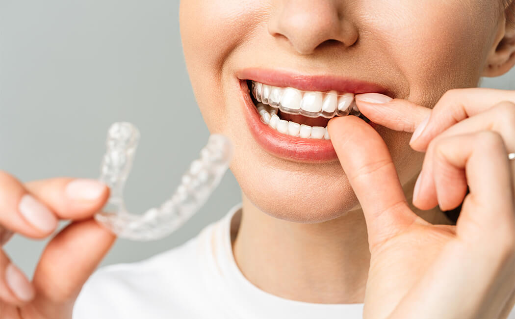 Aligners